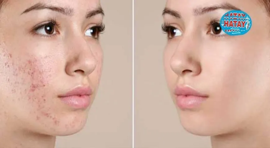 Akne genellikle hangi cilt tiplerinde oluşur?