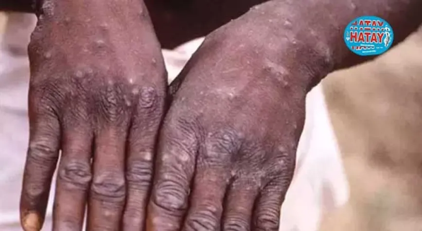 Ankara'da MPox karantinası  iddialarına yalanlama