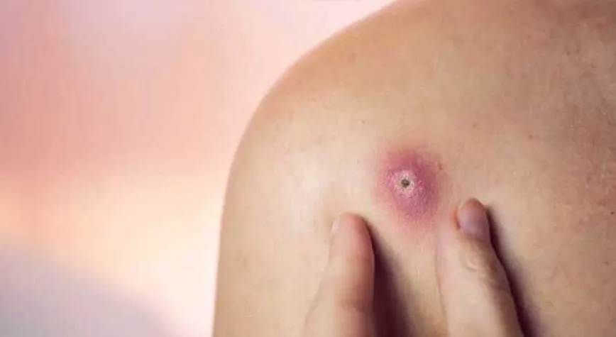 Apse Nasıl Tedavi Edilir?