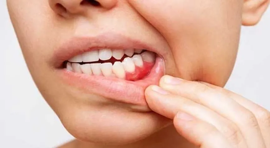 Diş Eti Çekilmesi Tedavi Seçenekleri