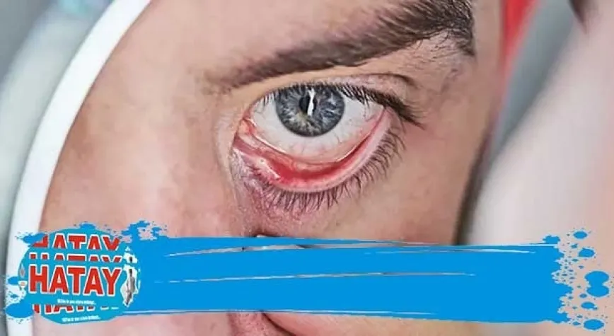 Diyabet Göz Sağlığını Etkiler Mi?