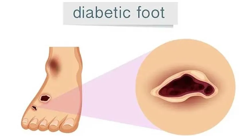 Diyabetik Ayak Nedir?