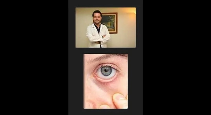 'GÖZ ETİ' RAHATSIZLIĞINDA ERKEN TEDAVİ ÖNEMLİ