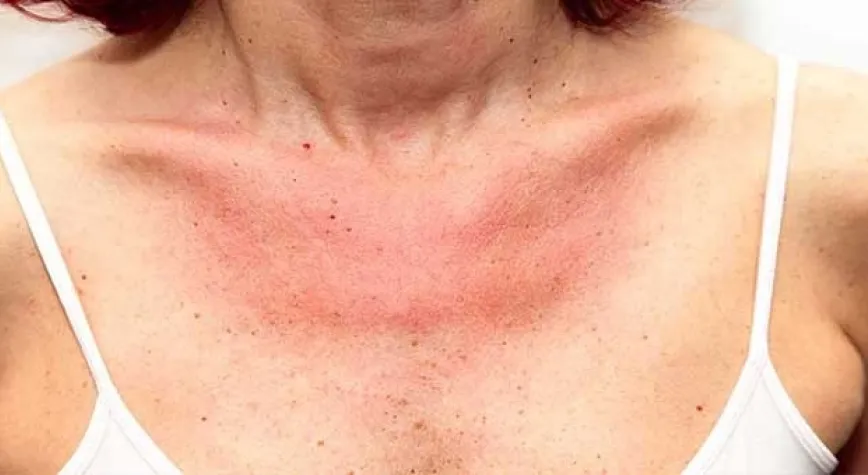 Güneş Alerjisi Nasıl Tedavi Edilir?