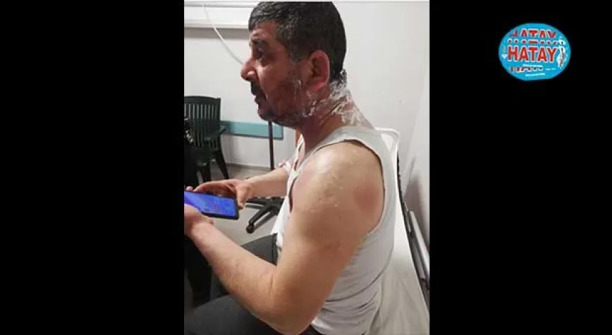 Hatay’da Meclis Üyesine Asitli saldırı