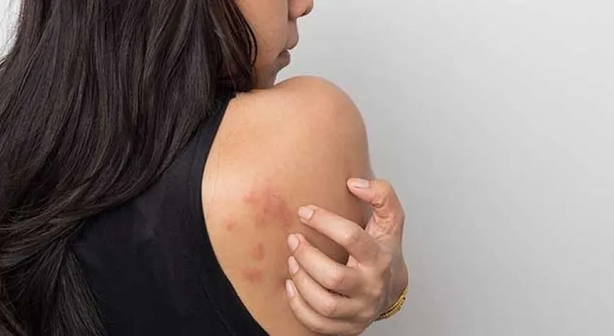 Kurdeşen Nedir? Nasıl Tedavi Edilir?