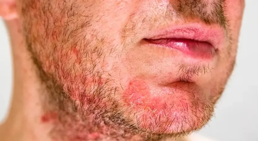 Seboreik Dermatite Neden Olan Nedir?