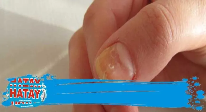 Tırnak mantarına ne iyi gelir?