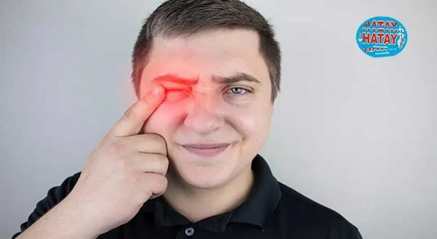 Üveit Nedir? Belirtileri ve Tedavi Yöntemleri