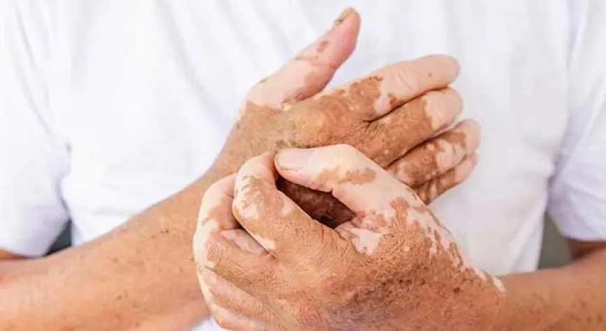 Vitiligo Tedavisi Nedir?