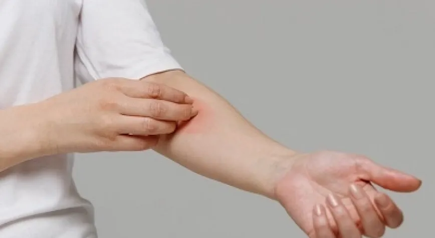 Vücut Yanığı Belirtileri Nelerdir?