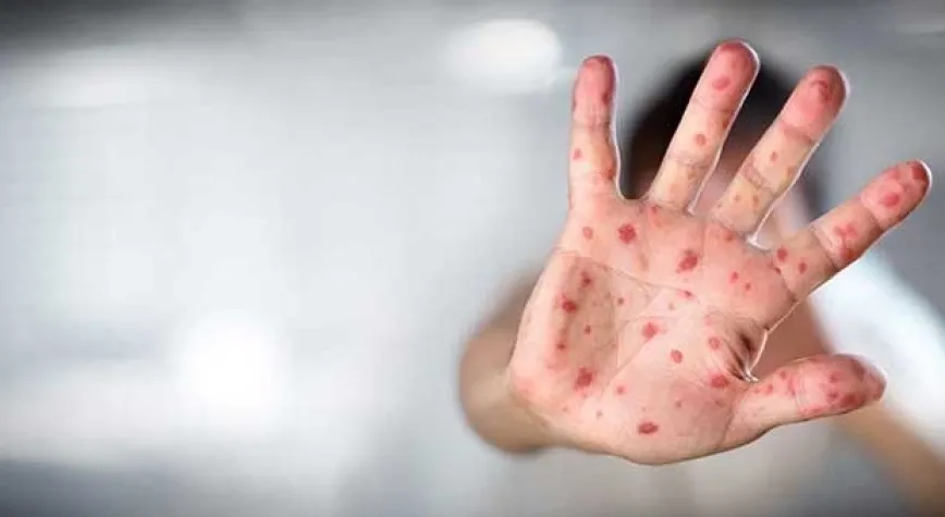 Zona hastalığı, bir enfeksiyon hastalığıdır